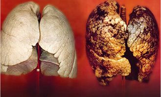 肺癌早期常见的症状