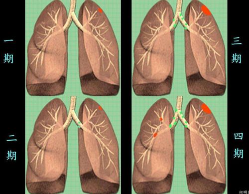 肺癌早期都有什么症状?