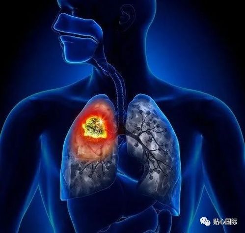 肺癌早期典型的临床症状是